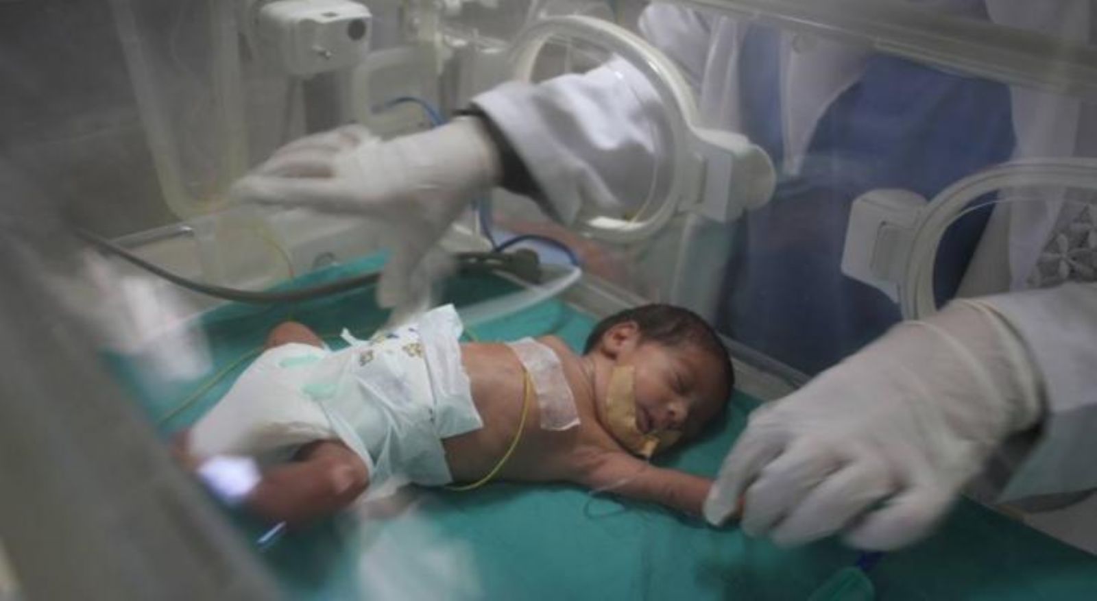 الاحتلال ترك 5 أطفال رضع حتى التحلل في حضانة مشفى النصر